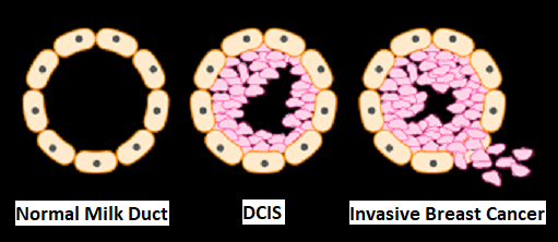 Normal-Milk-Duct  DCIS  Invasive-Breast-Cancer