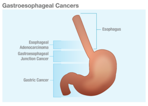 Gastroesophageal-Cancers